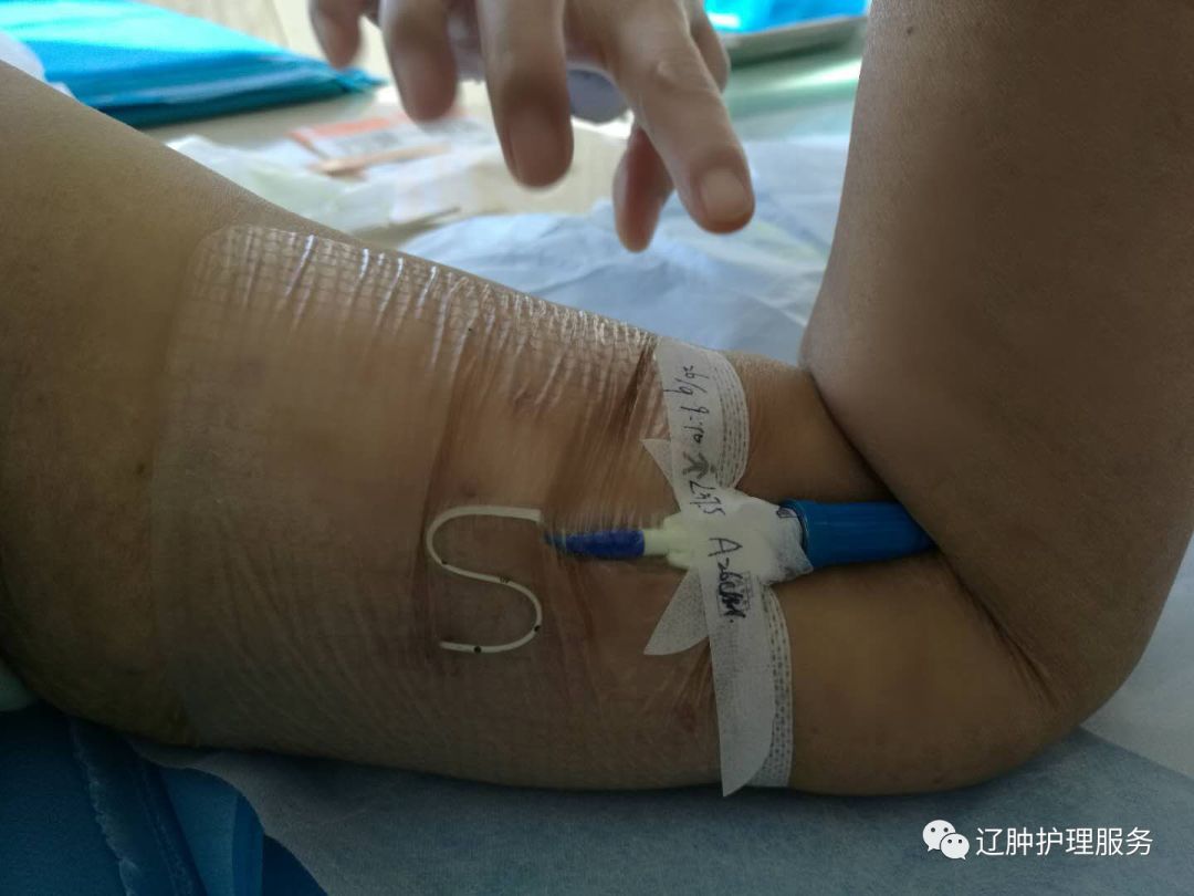 怎么撕敷料啊PICC：0°揭敷料，Ω固定法，好经验快收藏！_https://www.jmylbn.com_新闻资讯_第13张