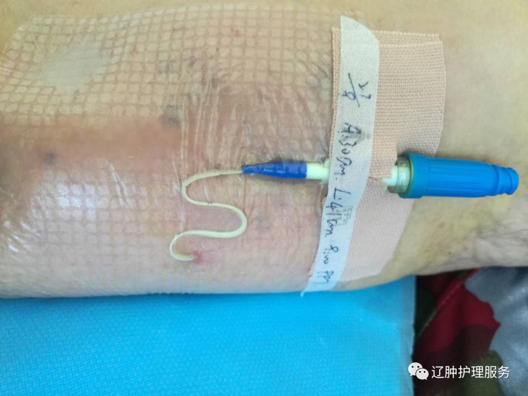 怎么撕敷料啊PICC：0°揭敷料，Ω固定法，好经验快收藏！_https://www.jmylbn.com_新闻资讯_第15张