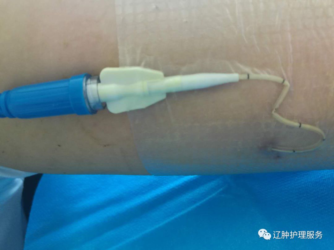 怎么撕敷料啊PICC：0°揭敷料，Ω固定法，好经验快收藏！_https://www.jmylbn.com_新闻资讯_第11张