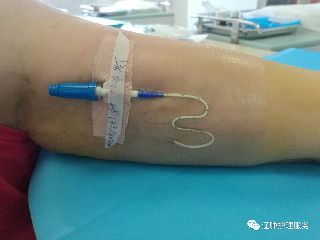 怎么撕敷料啊PICC：0°揭敷料，Ω固定法，好经验快收藏！_https://www.jmylbn.com_新闻资讯_第10张