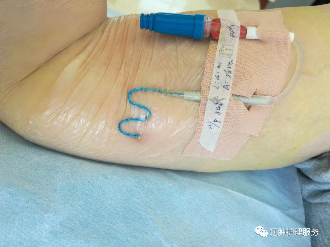怎么撕敷料啊PICC：0°揭敷料，Ω固定法，好经验快收藏！_https://www.jmylbn.com_新闻资讯_第14张