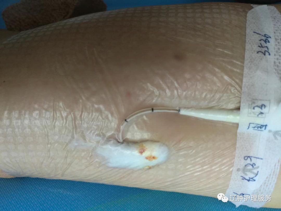 怎么撕敷料啊PICC：0°揭敷料，Ω固定法，好经验快收藏！_https://www.jmylbn.com_新闻资讯_第7张