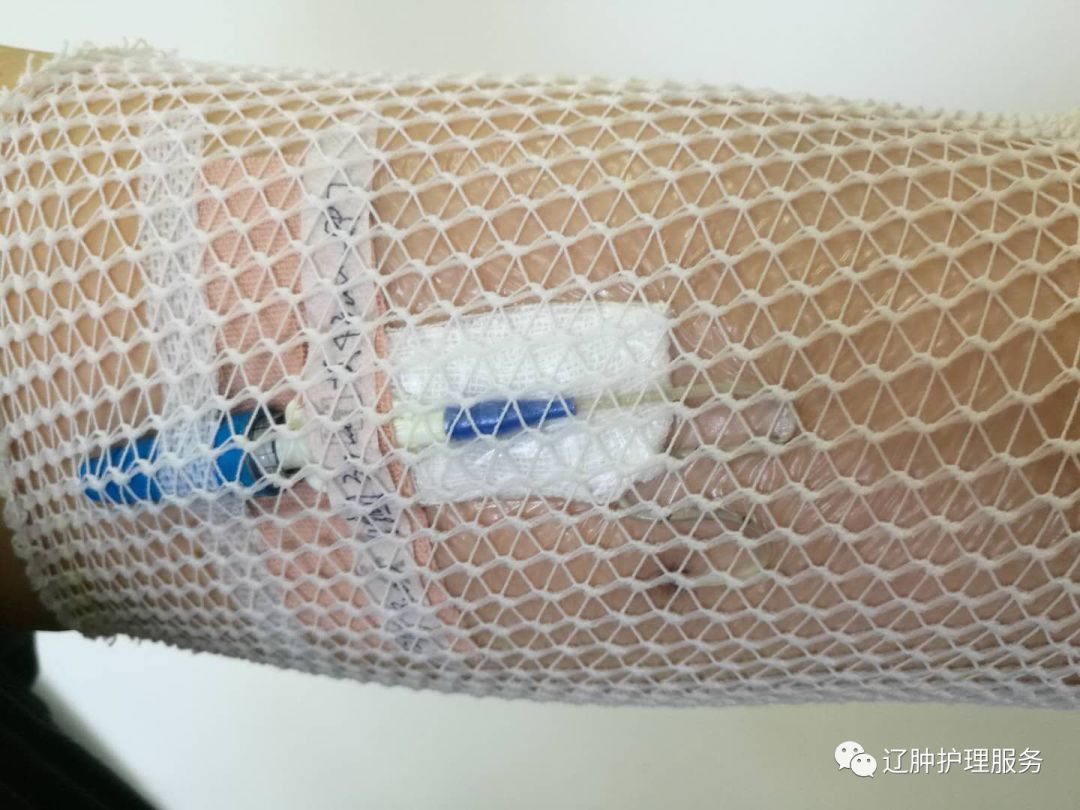 怎么撕敷料啊PICC：0°揭敷料，Ω固定法，好经验快收藏！_https://www.jmylbn.com_新闻资讯_第16张