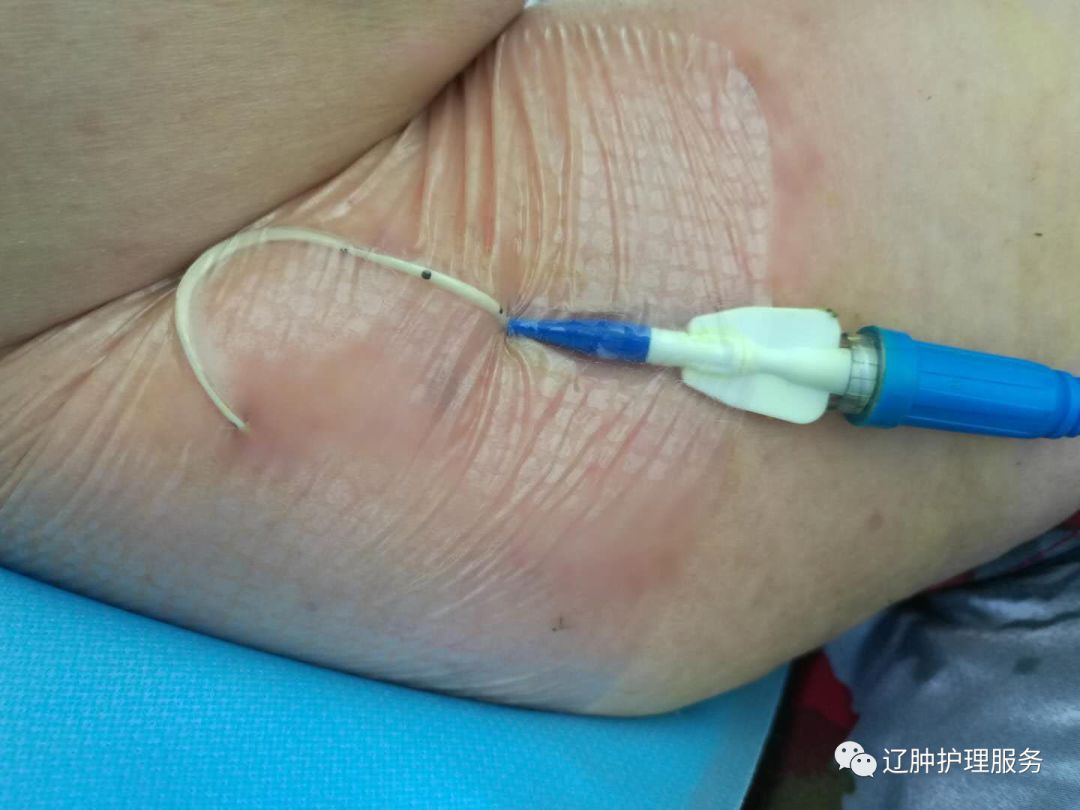 怎么撕敷料啊PICC：0°揭敷料，Ω固定法，好经验快收藏！_https://www.jmylbn.com_新闻资讯_第12张