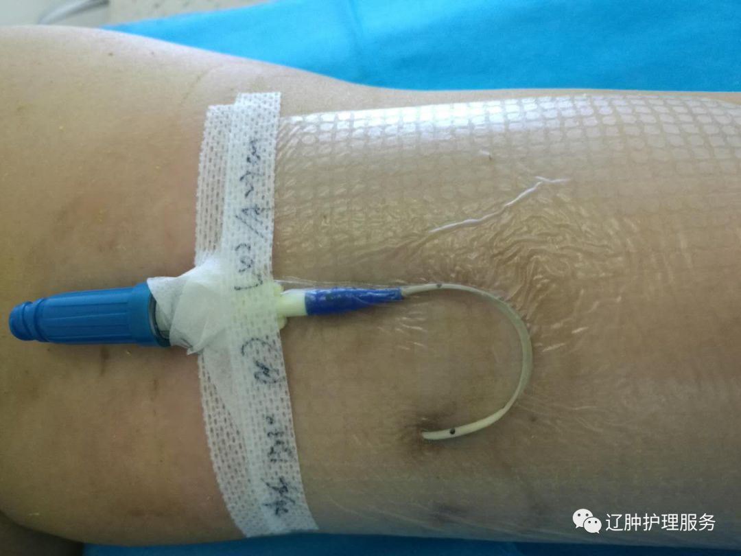 怎么撕敷料啊PICC：0°揭敷料，Ω固定法，好经验快收藏！_https://www.jmylbn.com_新闻资讯_第9张