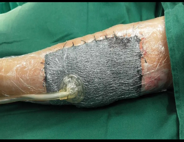 为什么负压引流VSD负压吸引术的健康宣教_https://www.jmylbn.com_新闻资讯_第3张