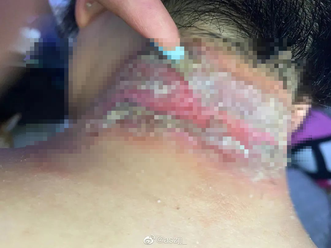 “会飞的硫酸”将进入活跃期，有人中招脖子烂了一圈