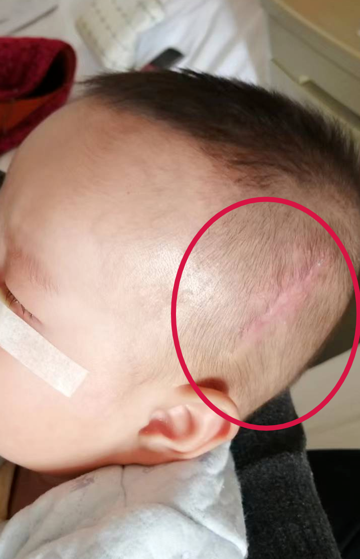 留置针怎么取出男婴输液时针头导管留体内5年，最近进展：已取出_https://www.jmylbn.com_新闻资讯_第10张