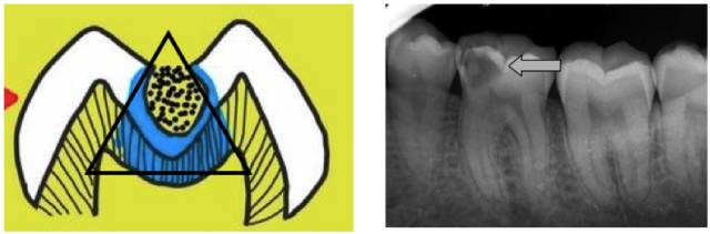 拔掉烂牙根多久才能补牙_烂牙根一般几年内必须拔_拔烂牙根有危险吗