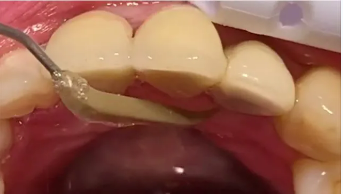 牙周治疗仪怎么做牙周【口腔健康】江西医专第一附属医院口腔科引进超声牙周治疗仪，助力牙齿健康_https://www.jmylbn.com_新闻资讯_第7张