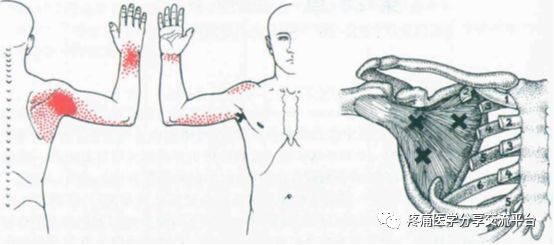 引起肩周炎后摸受限的软组织之一 肩胛下肌 疼痛医学分享交流平台 微信公众号文章阅读 Wemp