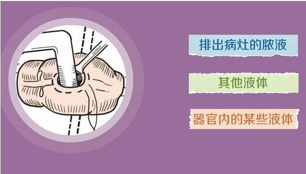 为什么要放负压球产品推荐｜一次性使用负压引流球_https://www.jmylbn.com_新闻资讯_第4张