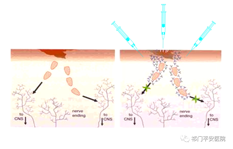 祁门平安医院狂犬病预防处置门诊开展狂犬病免疫球蛋白注射