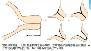 15周宫颈环扎20周失败_宫颈环扎了为什么宫颈还短了_宫颈环扎失败后还能再次怀孕吗