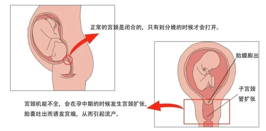 宫颈环扎了为什么宫颈还短了_15周宫颈环扎20周失败_宫颈环扎失败后还能再次怀孕吗