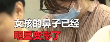 患鼻炎后的一个习惯，致16岁少女鼻子变形！