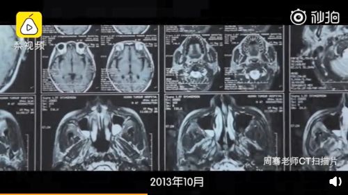 与鼻咽癌抗争了6年的大学副教授，最后留下一句被大部分人忽视的