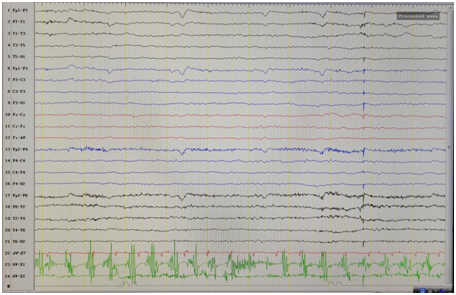 日本光电脑电图怎么样【特色门诊】被“癫痫”困扰？癫痫门诊为您带来精准治疗_https://www.jmylbn.com_新闻资讯_第13张
