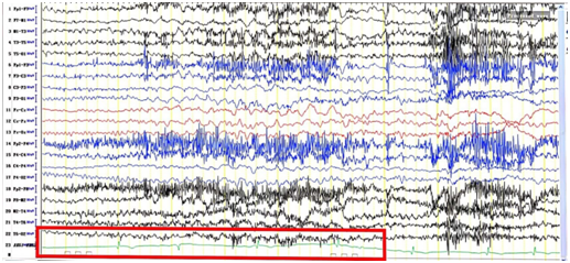 日本光电脑电图怎么样【特色门诊】被“癫痫”困扰？癫痫门诊为您带来精准治疗_https://www.jmylbn.com_新闻资讯_第11张