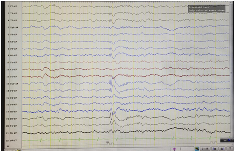 日本光电脑电图怎么样【特色门诊】被“癫痫”困扰？癫痫门诊为您带来精准治疗_https://www.jmylbn.com_新闻资讯_第12张
