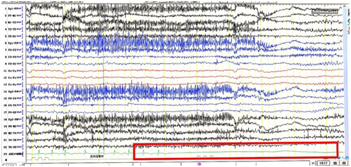 日本光电脑电图怎么样【特色门诊】被“癫痫”困扰？癫痫门诊为您带来精准治疗_https://www.jmylbn.com_新闻资讯_第10张