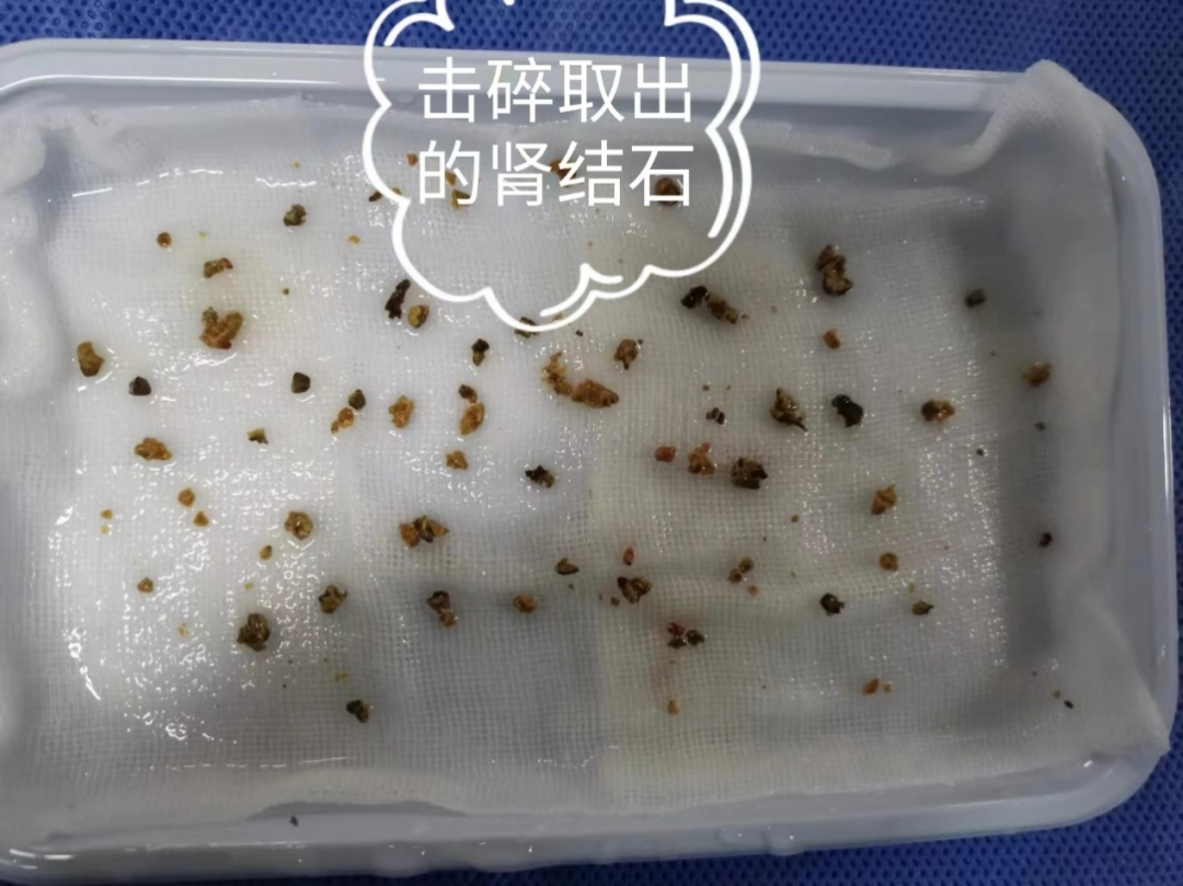 什么是输尿管镜【器械介绍】电子输尿管软镜_https://www.jmylbn.com_新闻资讯_第5张