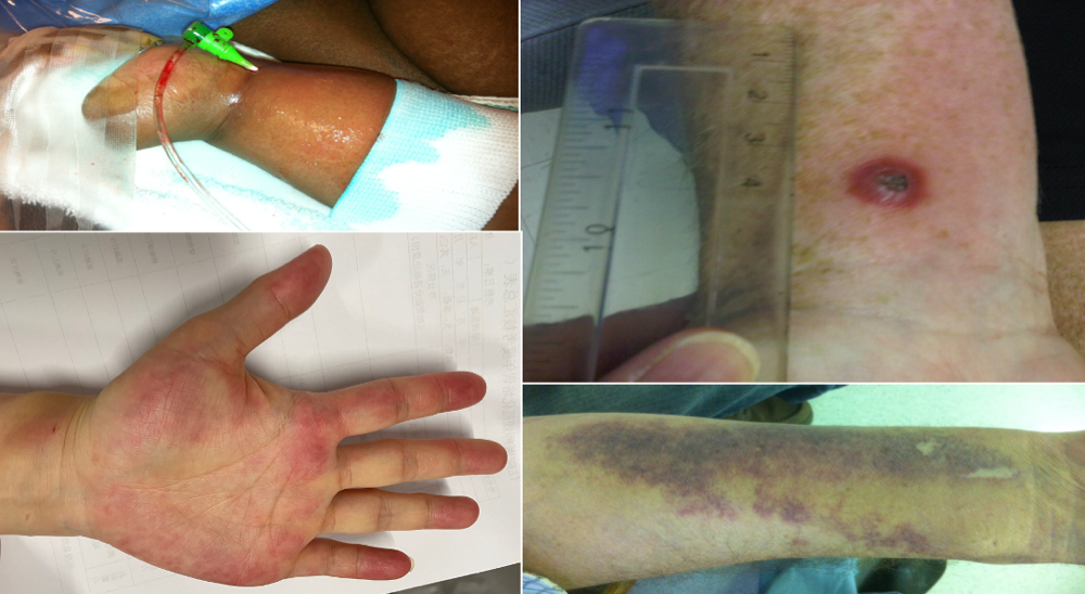 桡动脉鞘怎么读R.A.V.I.Club微课堂 · 经桡动脉外周介入之复旦中山篇第十一期_https://www.jmylbn.com_新闻资讯_第19张