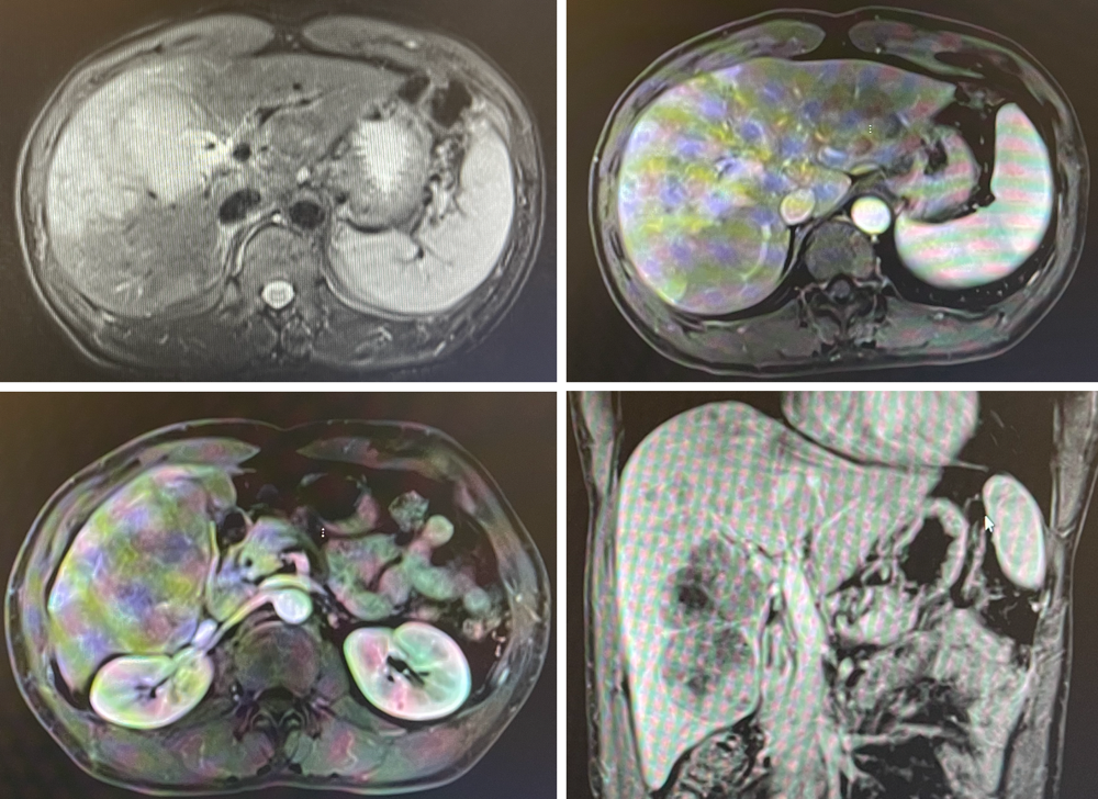 桡动脉鞘怎么读R.A.V.I.Club微课堂 · 经桡动脉外周介入之复旦中山篇第十一期_https://www.jmylbn.com_新闻资讯_第20张