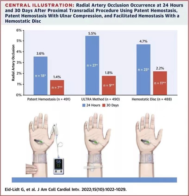 桡动脉鞘怎么读R.A.V.I.Club微课堂 · 经桡动脉外周介入之复旦中山篇第十一期_https://www.jmylbn.com_新闻资讯_第15张