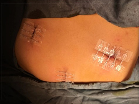 为什么要用皮肤吻合器手术后终于不用缝针啦！皮肤“拉链”，一拉就好，不留疤_https://www.jmylbn.com_新闻资讯_第8张