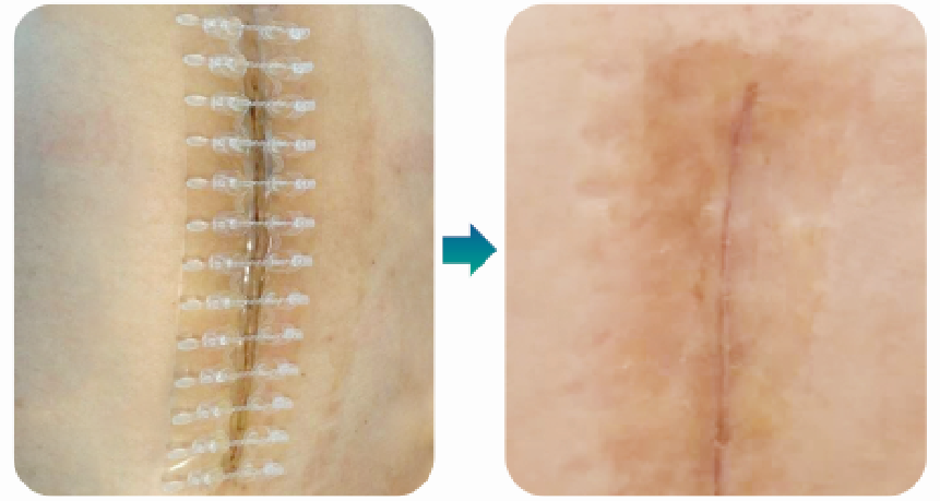 为什么要用皮肤吻合器手术后终于不用缝针啦！皮肤“拉链”，一拉就好，不留疤_https://www.jmylbn.com_新闻资讯_第12张