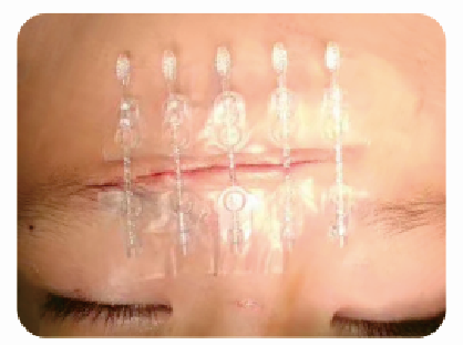 为什么要用皮肤吻合器手术后终于不用缝针啦！皮肤“拉链”，一拉就好，不留疤_https://www.jmylbn.com_新闻资讯_第14张