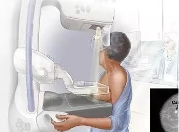 乳腺机为什么叫钼靶健康科普｜乳腺钼靶机让乳腺癌无处可藏！_https://www.jmylbn.com_新闻资讯_第22张