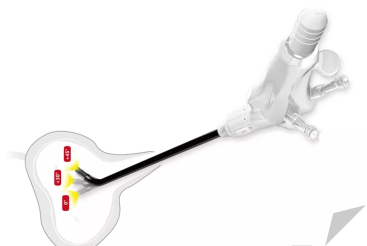 输尿管软镜有什么品牌国产替代加速｜近20家国产企业扎根一次性内窥镜领域！_https://www.jmylbn.com_新闻资讯_第3张