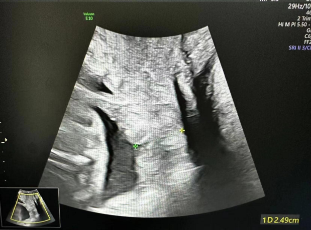 为什么要扩张宫颈孕妈不能承受之重：宫颈机能不全怎么办？_https://www.jmylbn.com_新闻资讯_第7张