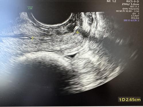 为什么要扩张宫颈孕妈不能承受之重：宫颈机能不全怎么办？_https://www.jmylbn.com_新闻资讯_第3张