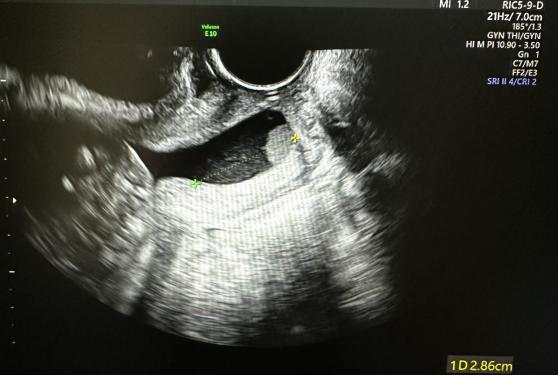 为什么要扩张宫颈孕妈不能承受之重：宫颈机能不全怎么办？_https://www.jmylbn.com_新闻资讯_第2张