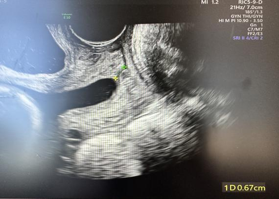 为什么要扩张宫颈孕妈不能承受之重：宫颈机能不全怎么办？_https://www.jmylbn.com_新闻资讯_第4张