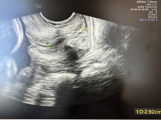 为什么要扩张宫颈孕妈不能承受之重：宫颈机能不全怎么办？_https://www.jmylbn.com_新闻资讯_第5张