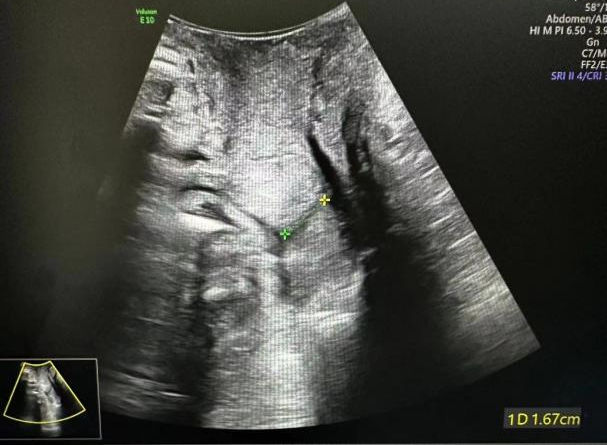 为什么要扩张宫颈孕妈不能承受之重：宫颈机能不全怎么办？_https://www.jmylbn.com_新闻资讯_第6张