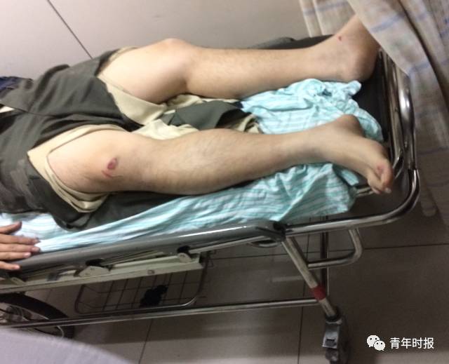 丁斐全身多处软组织挫伤