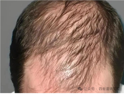 脂溢性脱发：看中医还是看西医效果好？皮肤科医生一次给你讲明白