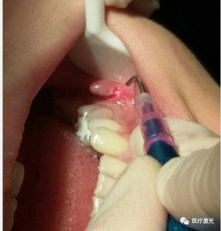 半导体激光治疗仪怎么样半导体激光口腔治疗仪在口腔临床治疗中常见问题解答_https://www.jmylbn.com_新闻资讯_第6张