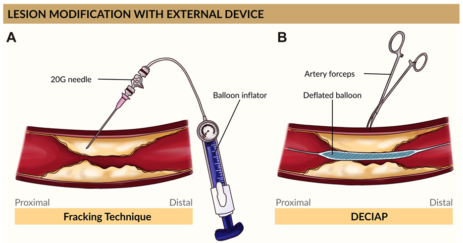 动脉钳怎么用动脉重度钙化导丝无法通过 针具技术超补救策略_https://www.jmylbn.com_新闻资讯_第8张