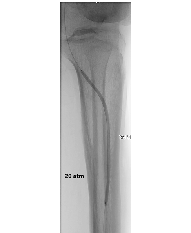 动脉钳怎么用动脉重度钙化导丝无法通过 针具技术超补救策略_https://www.jmylbn.com_新闻资讯_第35张