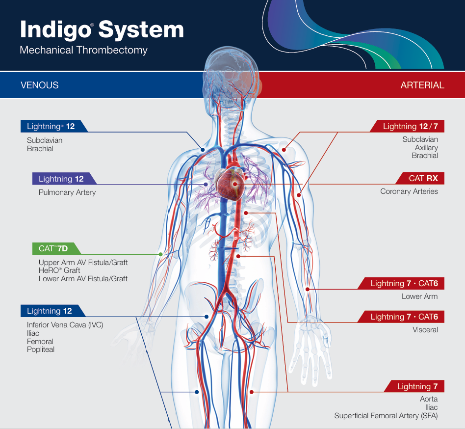 医学上ipc是什么米国静脉论坛上肢深静脉血栓临床指南与深度解析_https://www.jmylbn.com_新闻资讯_第24张