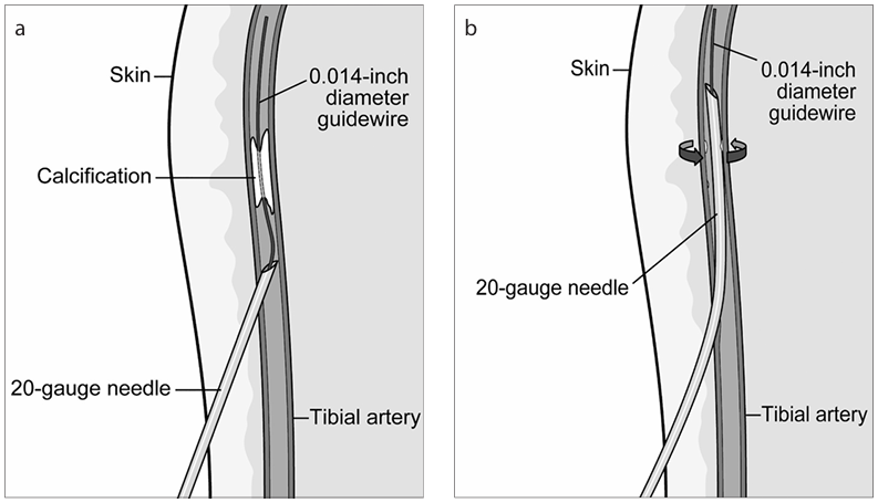 动脉钳怎么用动脉重度钙化导丝无法通过 针具技术超补救策略_https://www.jmylbn.com_新闻资讯_第18张