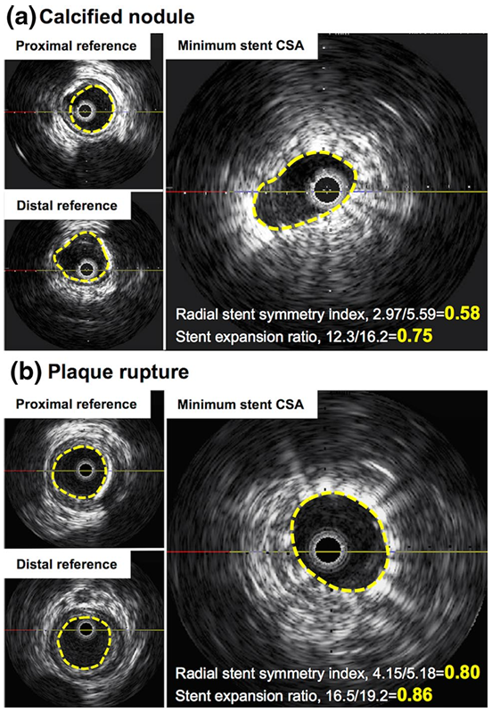动脉钳怎么用动脉重度钙化导丝无法通过 针具技术超补救策略_https://www.jmylbn.com_新闻资讯_第16张