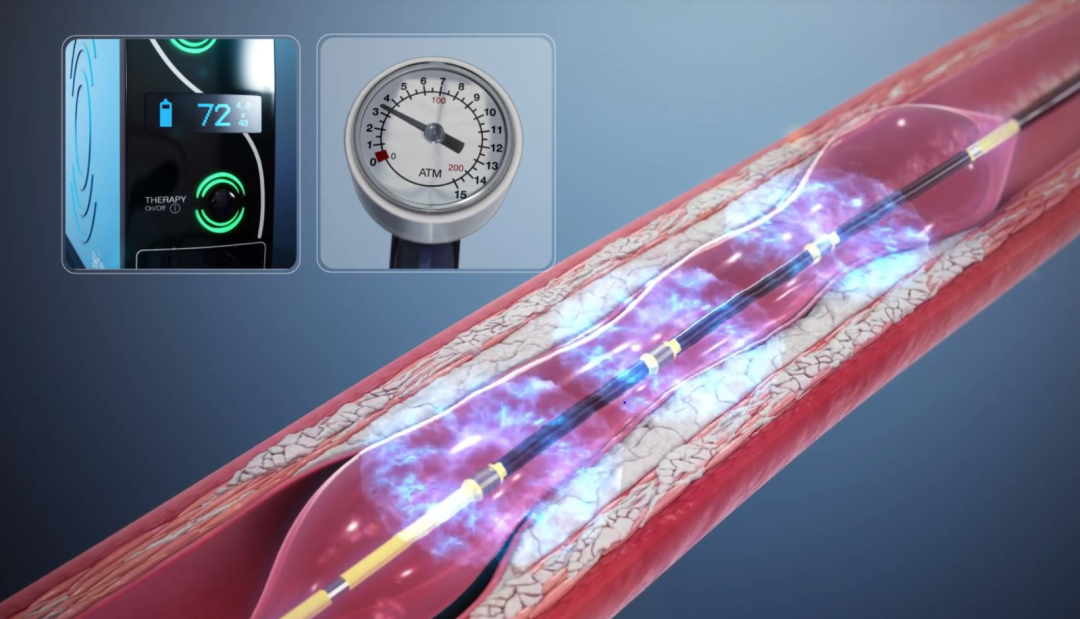 动脉钳怎么用动脉重度钙化导丝无法通过 针具技术超补救策略_https://www.jmylbn.com_新闻资讯_第36张