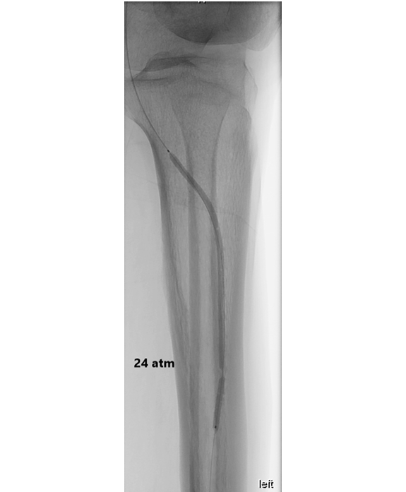 动脉钳怎么用动脉重度钙化导丝无法通过 针具技术超补救策略_https://www.jmylbn.com_新闻资讯_第33张